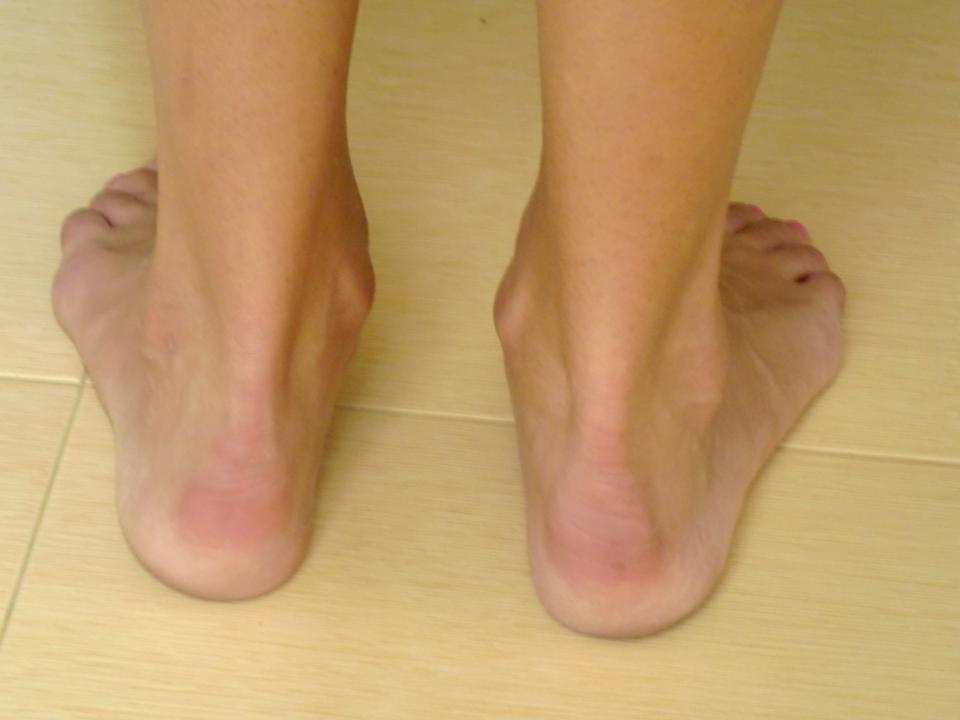 Barefoot Running As Possible Treatment for Flat Feet
