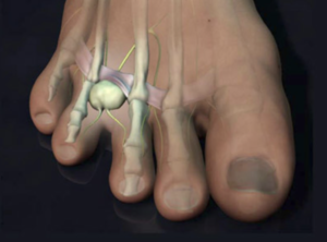 Hammertoes - Texas Foot and Ankle Consultants(Dr. Delpak & Dr. Errico)