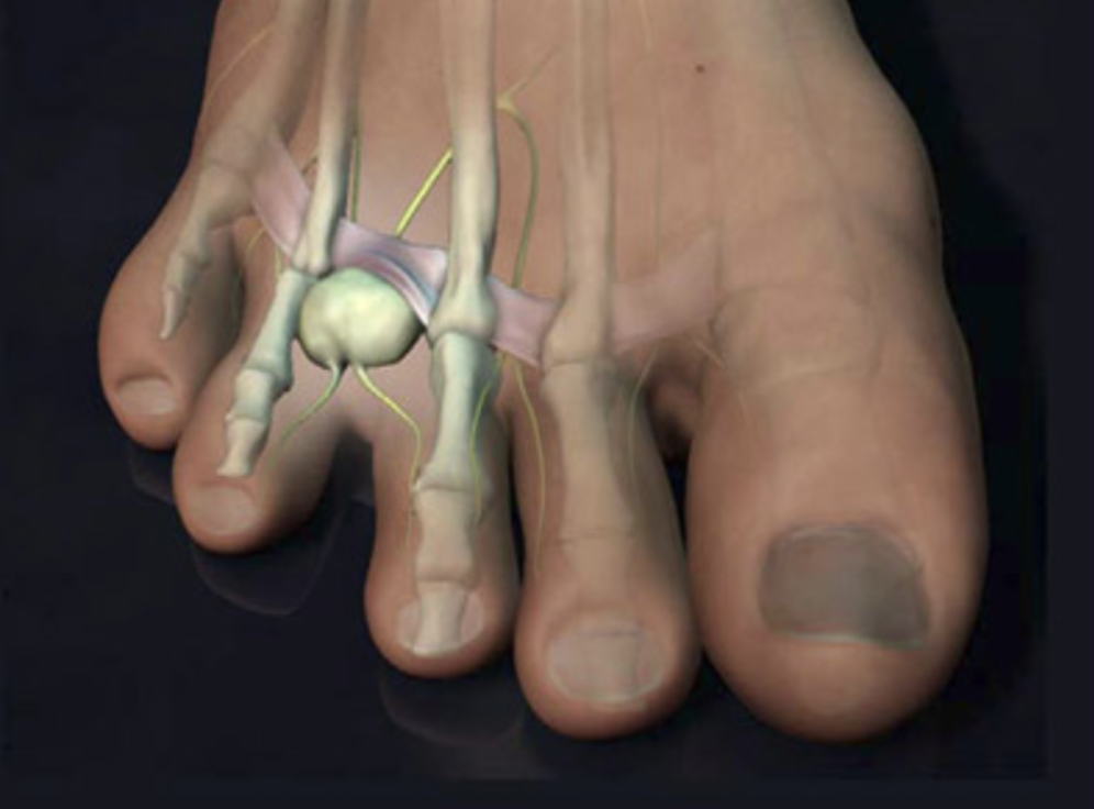 Neuroma Mortons Neuroma Causes Of Neuroma Neuroma Treatment In