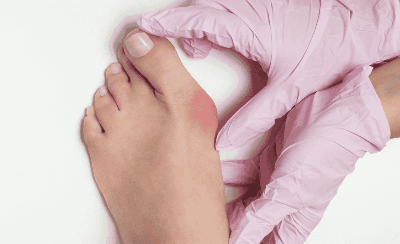 Understanding Bunions Causes Symptoms And Treatment Options Texas Foot And Ankle