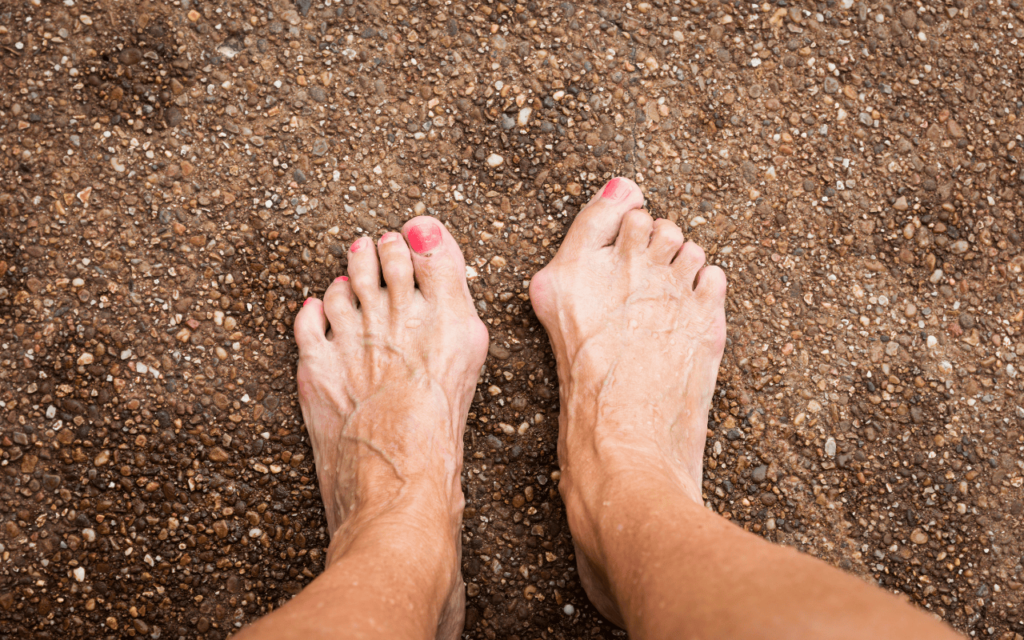 Hammertoe treatment with txt foot and consultants Dr. Delpak